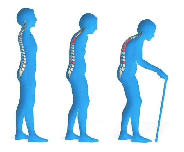 progression_of_osteoporosis