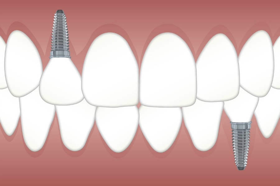 why get dental implants