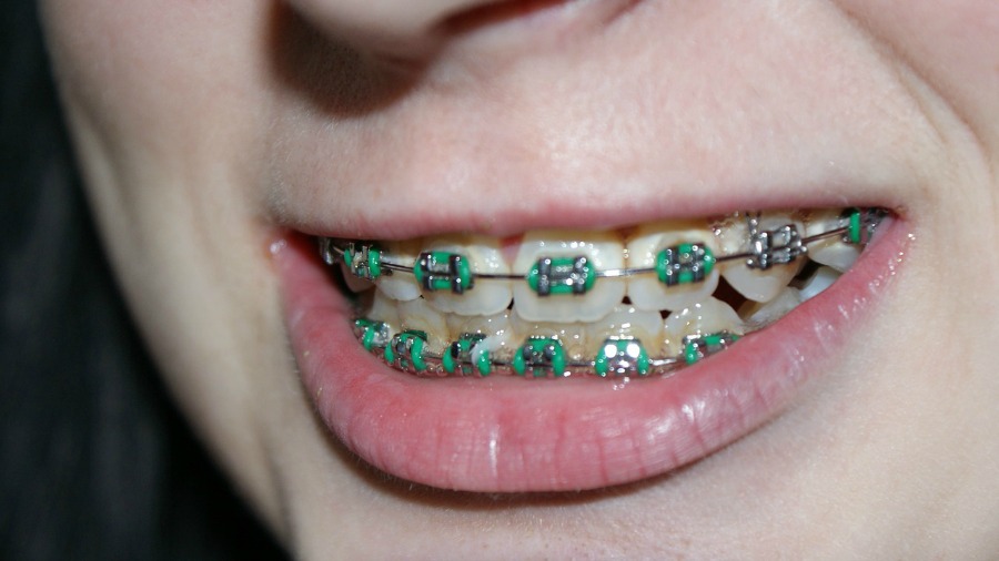 different types of braces metal braces