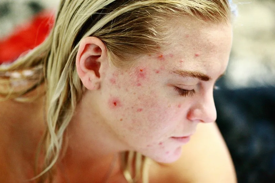 acne like this can damage your child's self-esteem so listen to their worries about their app