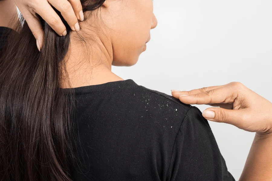 dandruff on shoulder of a dark shirt