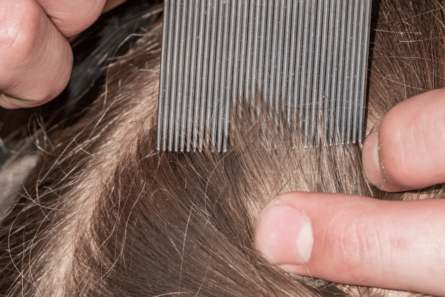 Lice vs. Dandruff A Complete Guide Bullock's Buzz