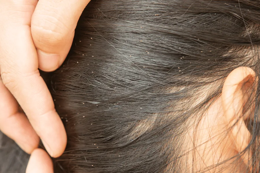 lice vs. dandruff nits in hair
