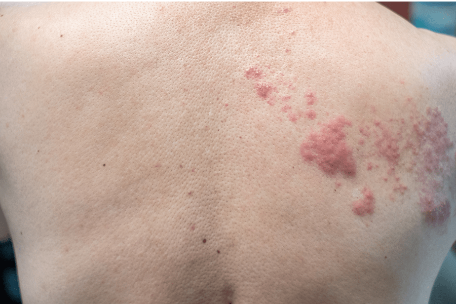 CBD can help with pain from shingles like these on this man's back