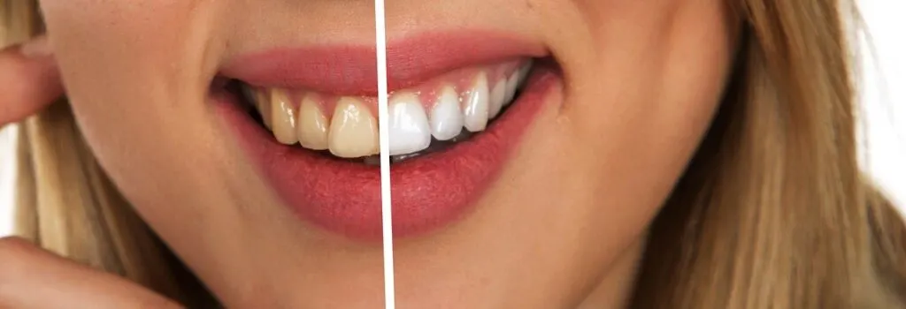 before and after teeth whitening images 