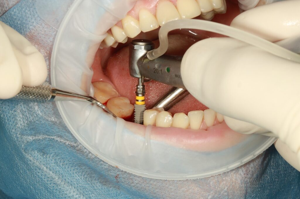 person getting dental implants