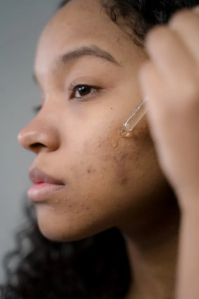 A woman applying serum to acne and discoloration on her face.