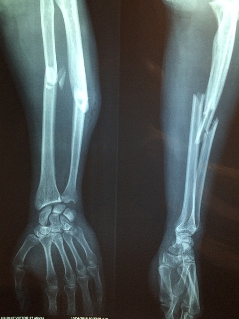 Xray of a broken arm needing post-injury health improvement