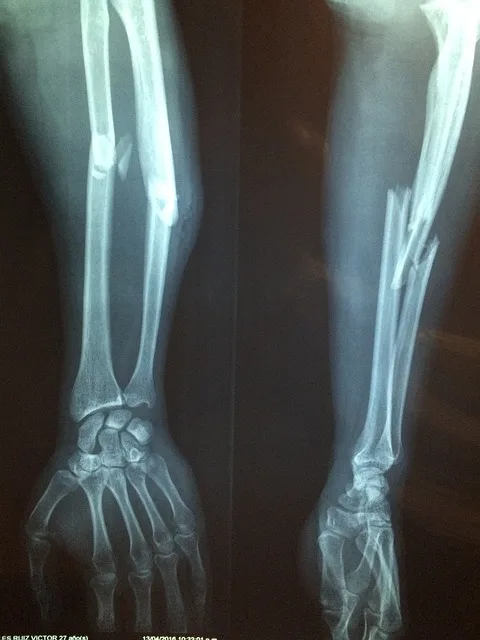 Xray of a broken arm needing post-injury health improvement