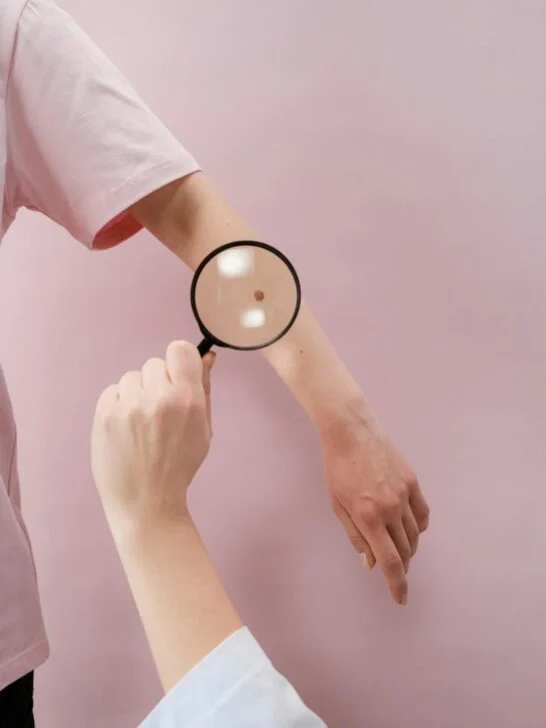 &ldquo;Dermatologist examining a mole on a patient&rsquo;s arm with a magnifying glass as part of skin check and cancer prevention tips.