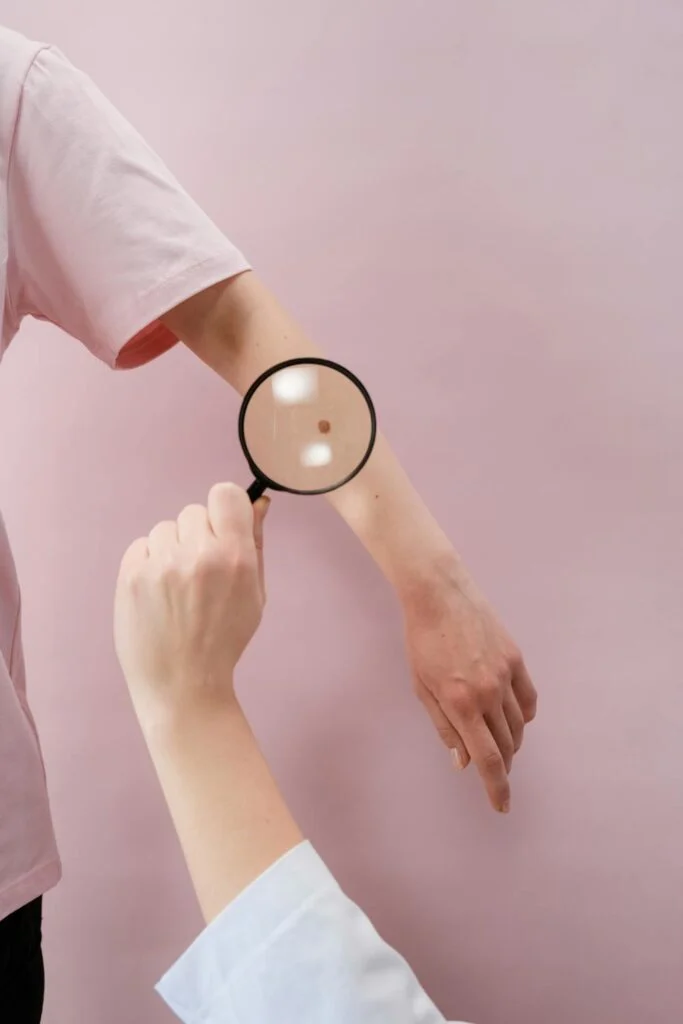Dermatologist examining a mole on a patient’s arm with a magnifying glass as part of skin check and cancer prevention tips