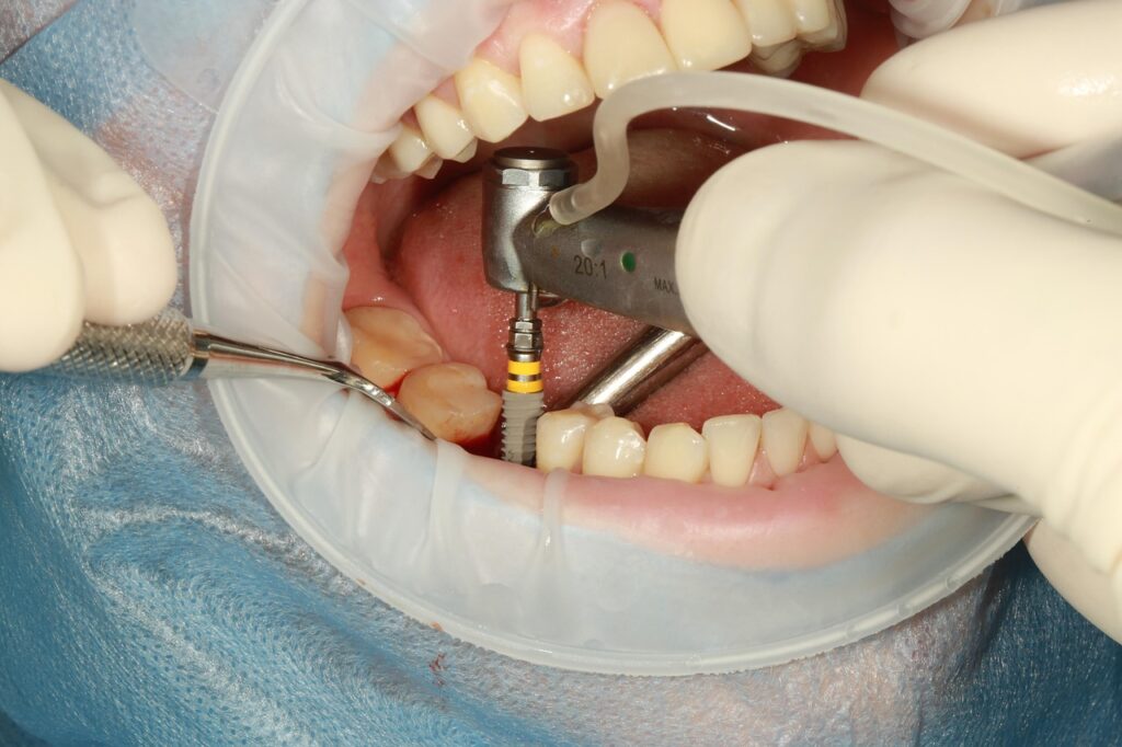 Close-up of dental implant placement showing tools and procedure inside patient’s mouth