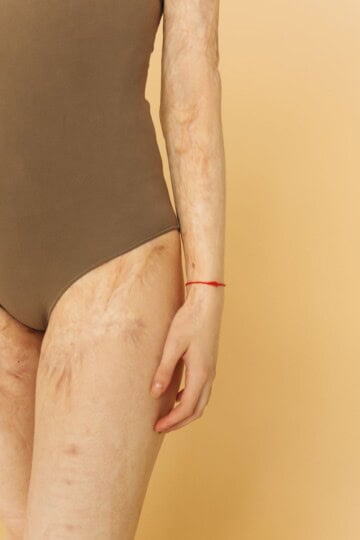 Close-up of a person’s thigh and hand with visible skin texture and discoloration.