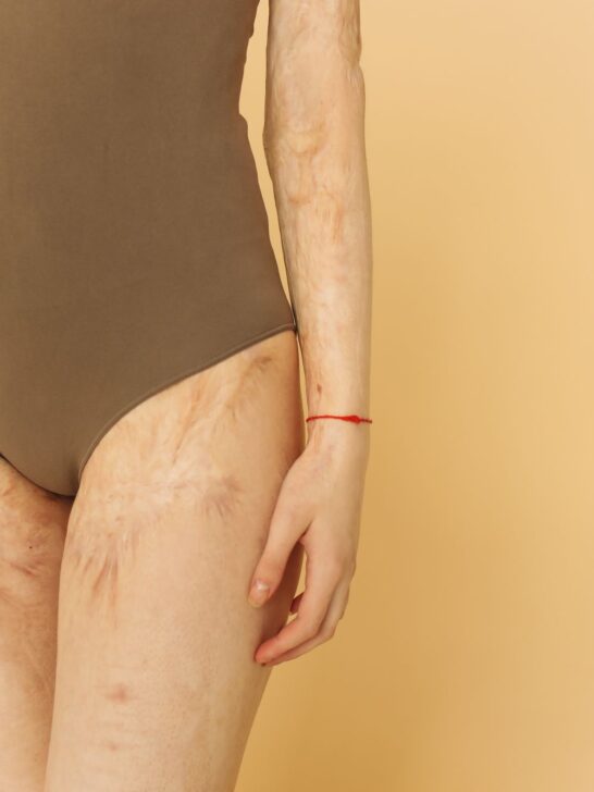 Close-up of a person&rsquo;s thigh and hand with visible skin texture and discoloration.