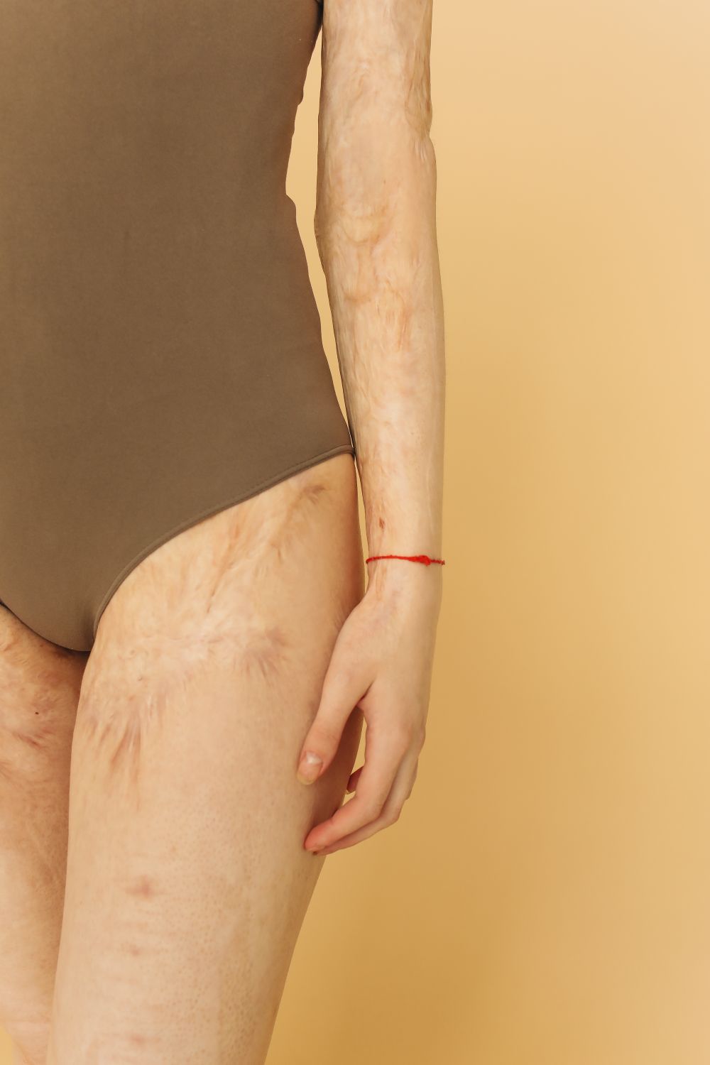 Close-up of a person’s thigh and hand with visible skin texture and discoloration.